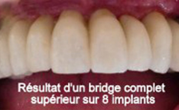 Bridge complet au maxillaire supérieur sur 8 implants