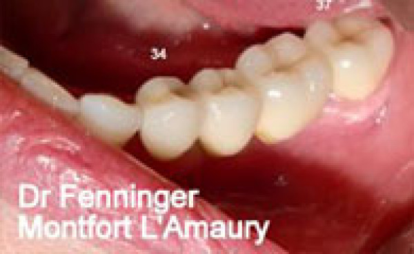Exemples de bridges de 3 ou 4 dents en céramique sur dents vivantes