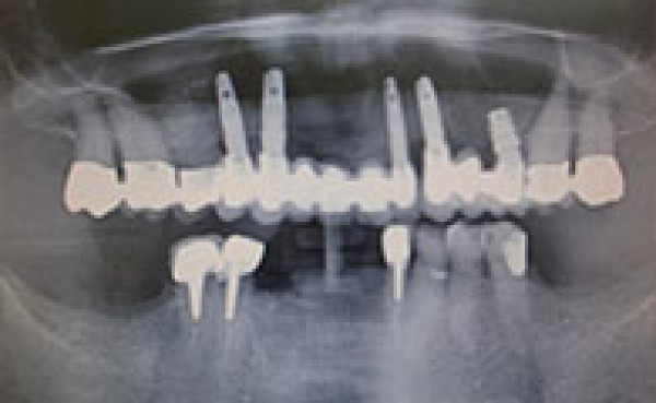Cas Clinique - Réhabilitation complète au maxillaire supérieur